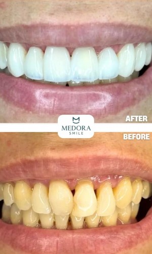 Dental Treatment in Turkey | Trusted Dental Consultancy | Medora Smile
