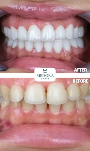 Dental Treatment in Turkey | Trusted Dental Consultancy | Medora Smile
