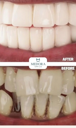 Dental Treatment in Turkey | Trusted Dental Consultancy | Medora Smile