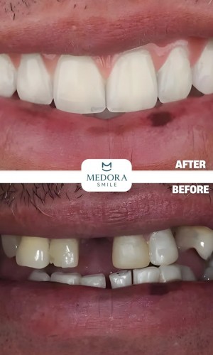 Dental Treatment in Turkey | Trusted Dental Consultancy | Medora Smile