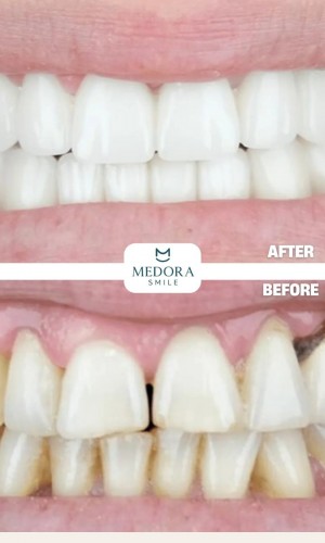 Dental Treatment in Turkey | Trusted Dental Consultancy | Medora Smile