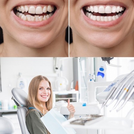 Dental Crowns
